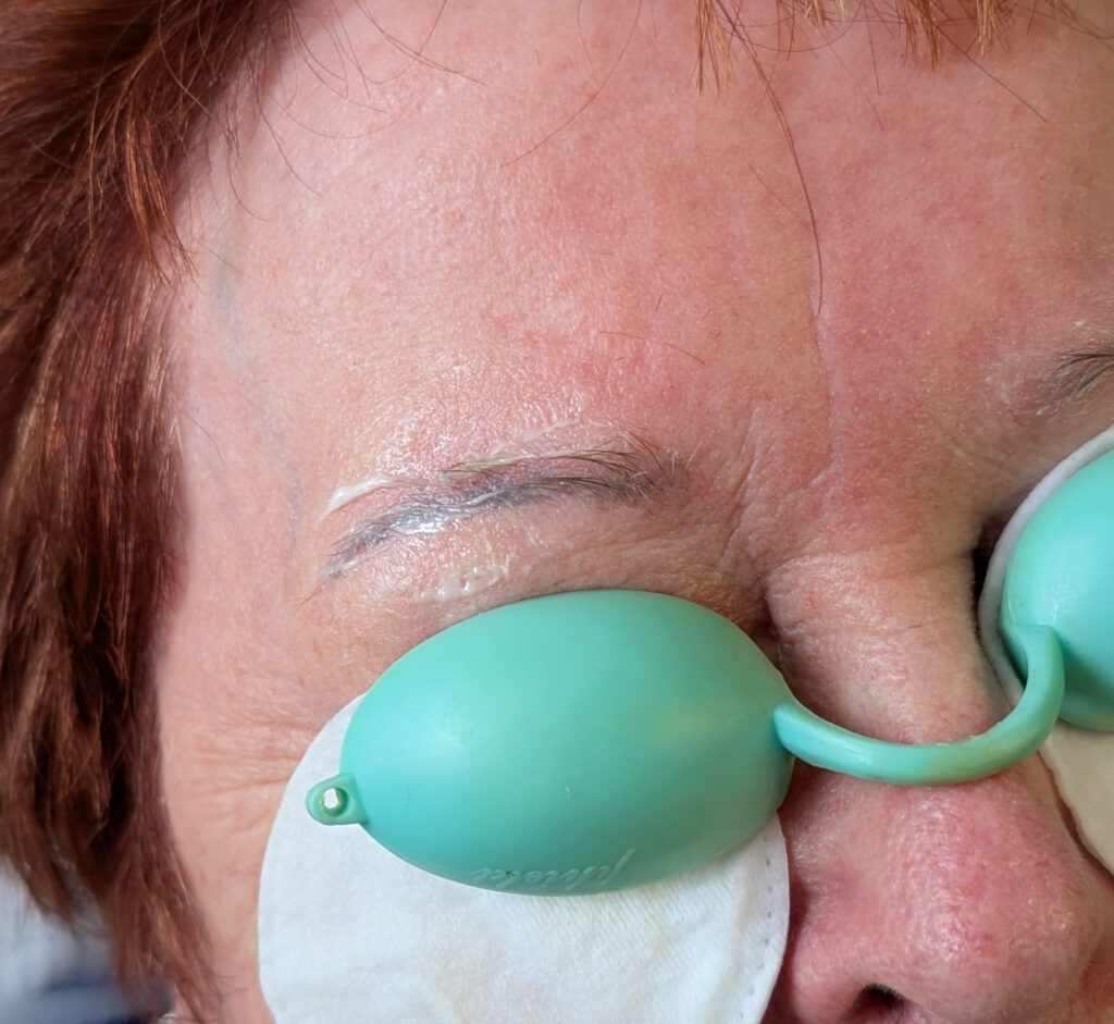 wenkbrauwen voor laserverwijdering PMU Linda Soer Epe
